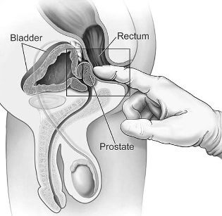 prostatita bacteriană cronică la bărbați